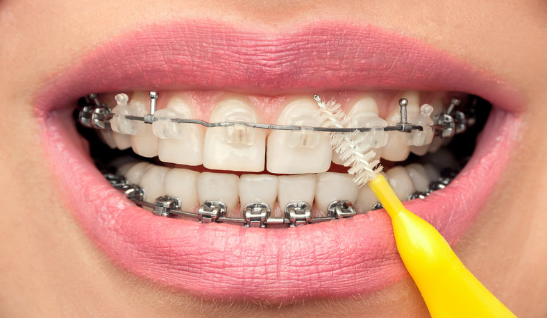 How to Take Care of Your Dental Braces