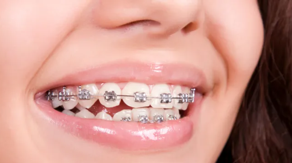 smiling with braces